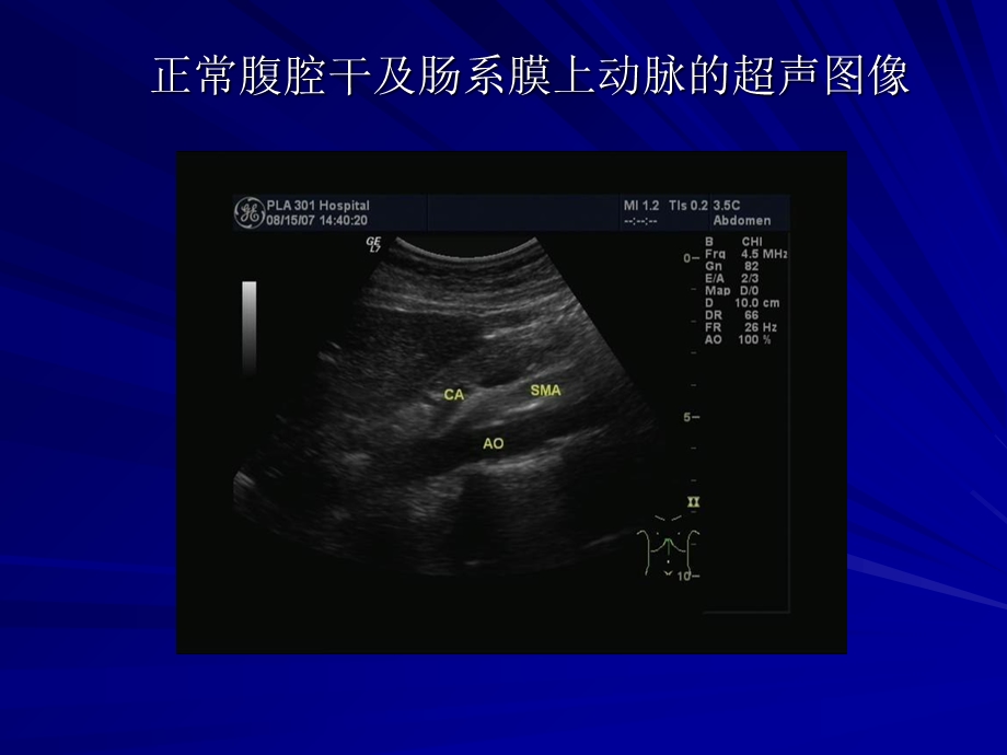 《腹部血管急诊》PPT课件.ppt_第3页