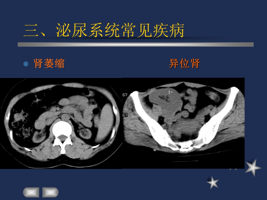 肾脏各种先天发育.ppt_第3页