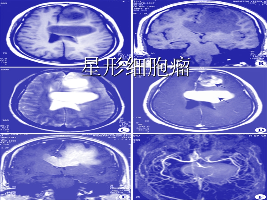 《星形细胞瘤》PPT课件.ppt_第1页