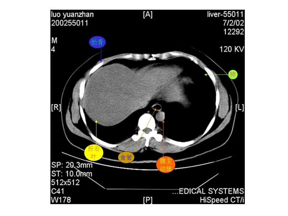 《腹部CT解剖图示》PPT课件.ppt_第2页