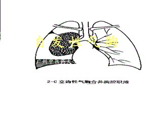 《自发性气胸》PPT课件.ppt