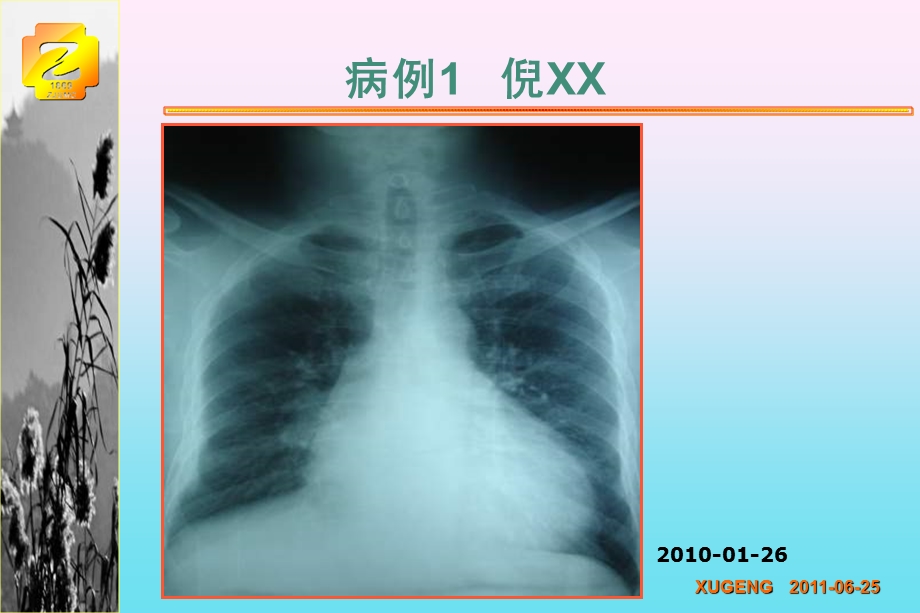 轻度心衰CRT时机已经来到最新循证医学证据解读课件.ppt_第2页