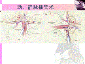 《动静脉插管术》PPT课件.ppt