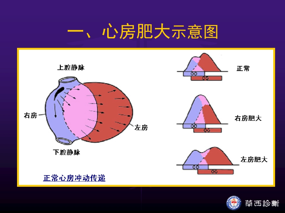 心电图心脏肥大.ppt_第3页