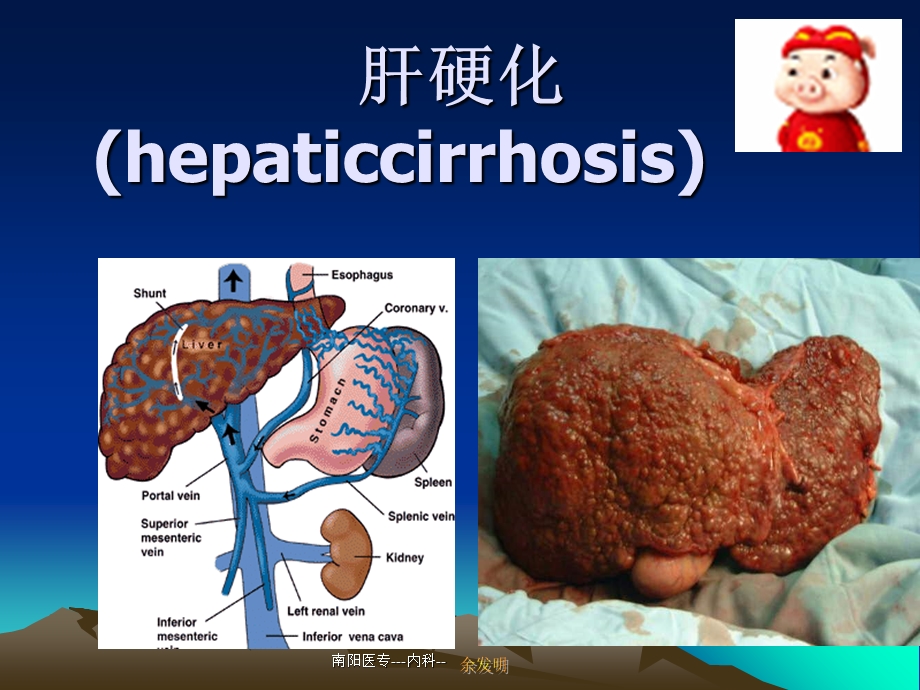 《肝硬化完整》PPT课件.ppt_第1页