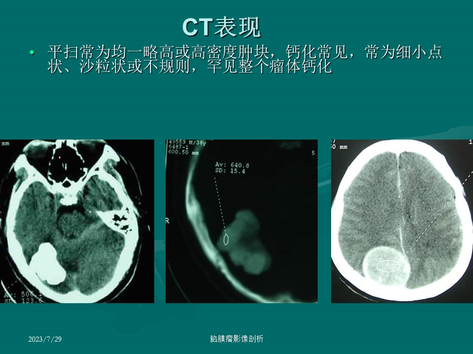 《脑膜瘤ct表现》PPT课件.ppt_第3页