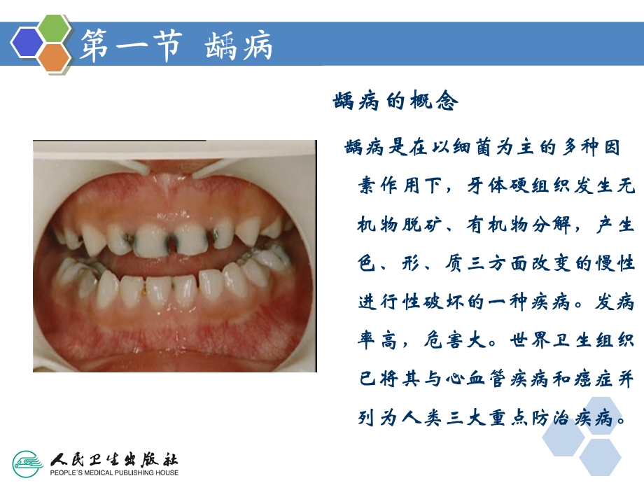 《牙体牙周组织疾病》PPT课件.ppt_第3页