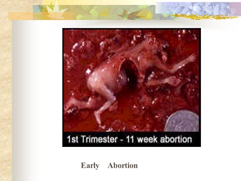 Abortion流产——妇产科学文档资料.ppt_第3页