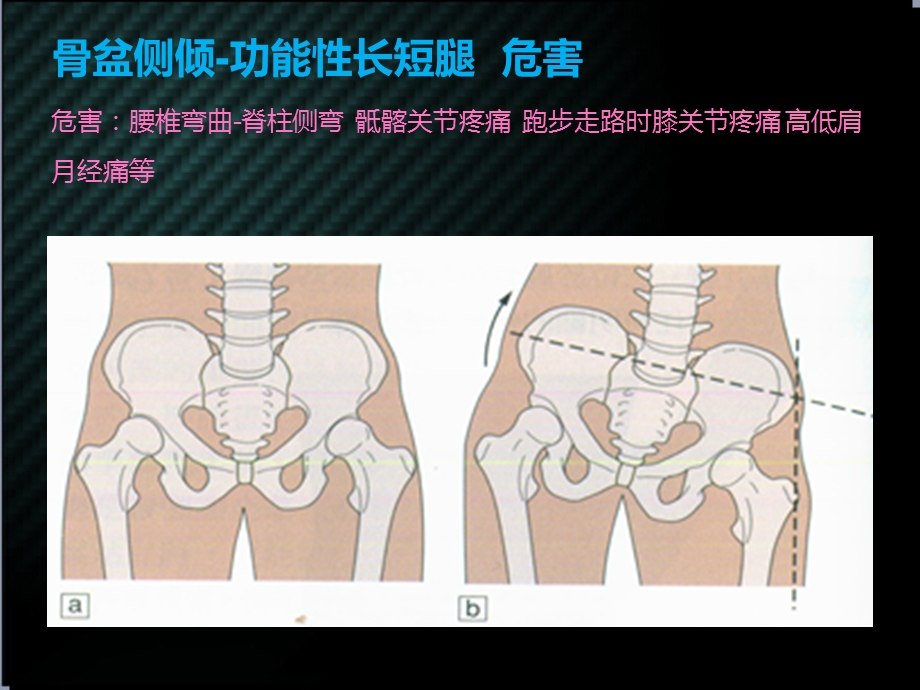 髋关节实用康复课程.ppt_第3页