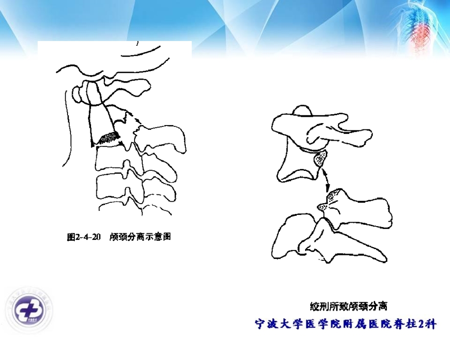 hangman骨折文档资料.ppt_第3页