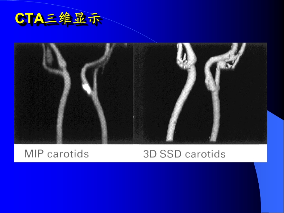 CT血管成像(脑血管)PPT文档.ppt_第3页