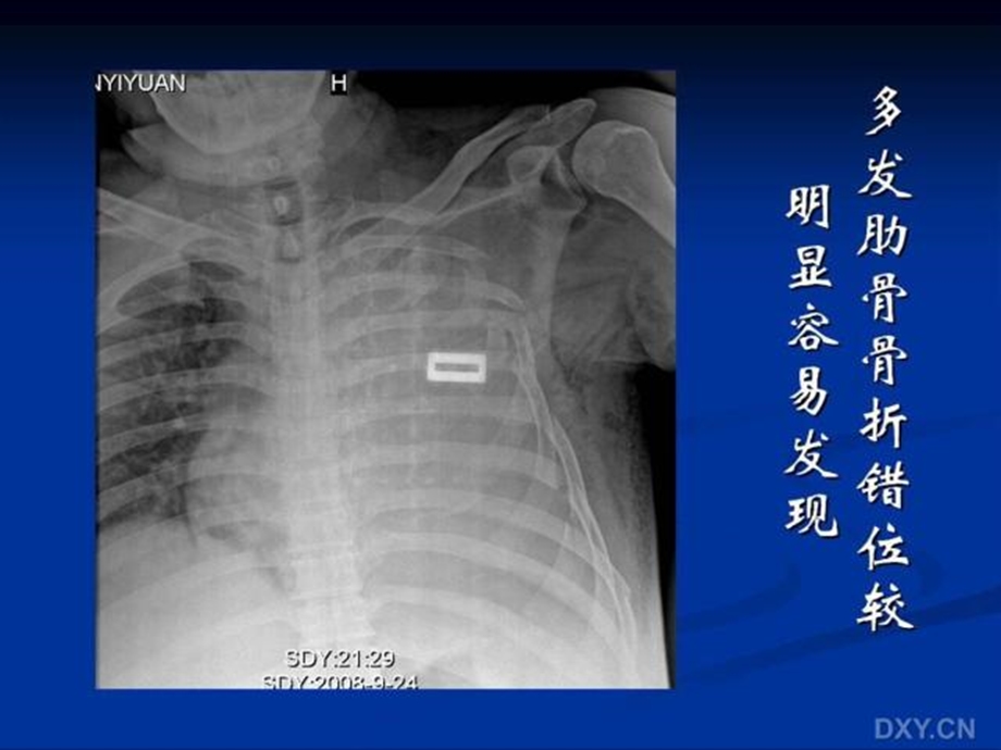 4胸部外伤影像学诊断文档资料.ppt_第3页