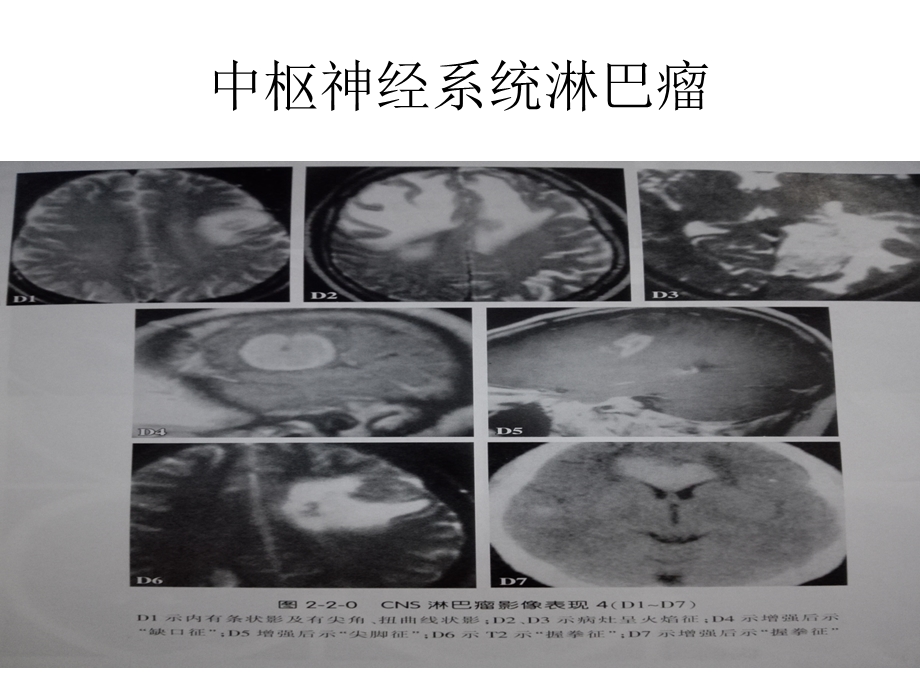 医学课件神经系统疾病图片.ppt_第2页