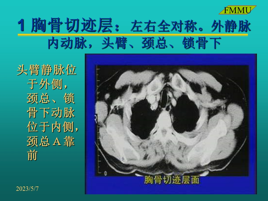 CT读片胸部西京医院呼吸科课件PPT文档.ppt_第3页