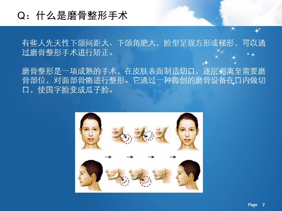 医学课件磨骨整形手术.ppt_第2页