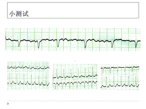 icu常见心律失常文档资料.ppt