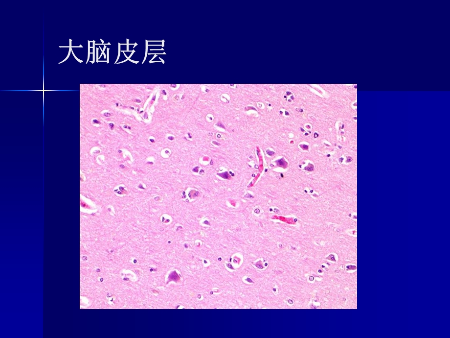 医学课件神经系统疾病带图.ppt_第3页