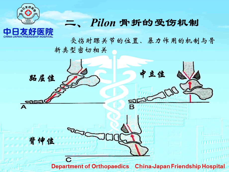 Pilon骨折诊断和治疗精选文档.ppt_第2页