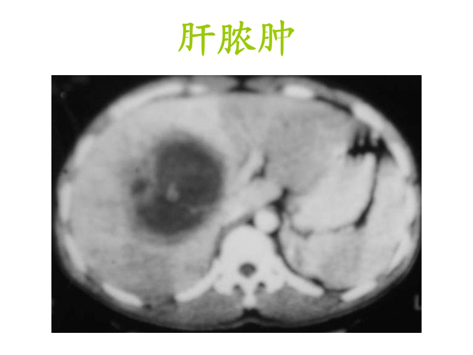 《肝脏疾病影像诊断》PPT课件.ppt_第1页