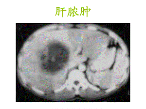 《肝脏疾病影像诊断》PPT课件.ppt