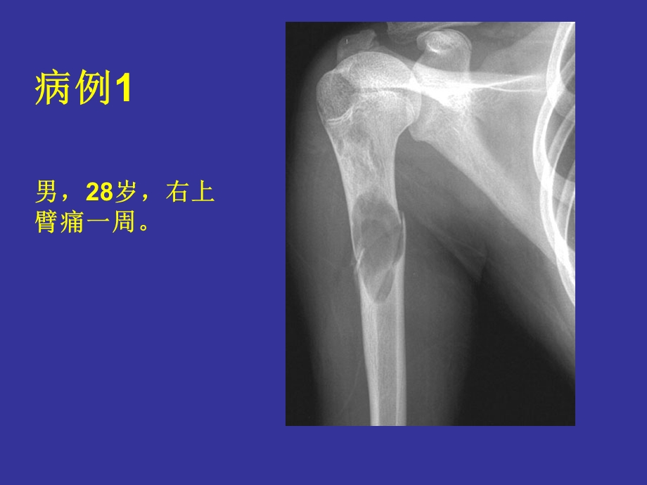 《骨骼囊性病变》PPT课件.ppt_第3页