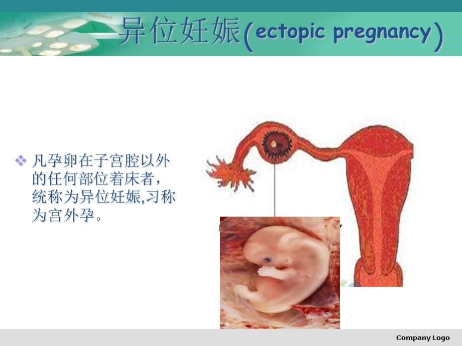 《异位妊娠公莉》PPT课件.ppt_第2页