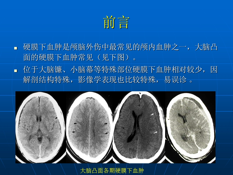 《小脑幕硬膜下血肿》PPT课件.ppt_第3页