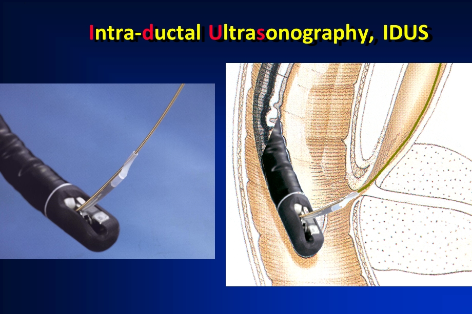 IDUS对胆胰管疾病的应用体会.ppt_第2页