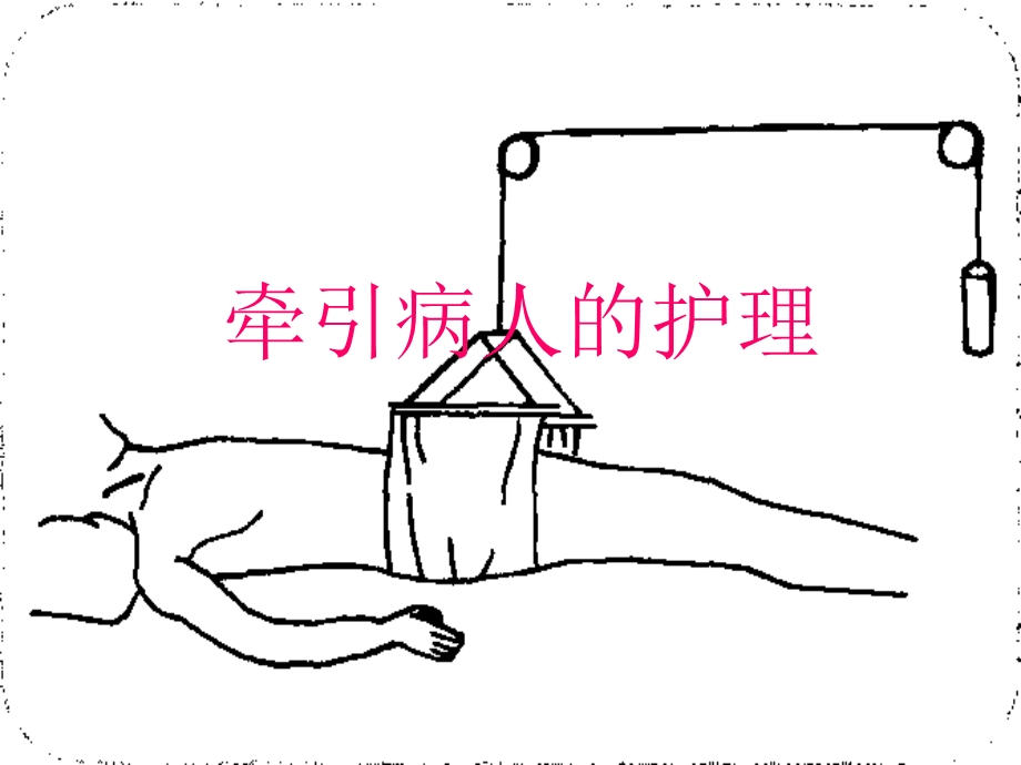 《牵引病人的护理》PPT课件.ppt_第1页