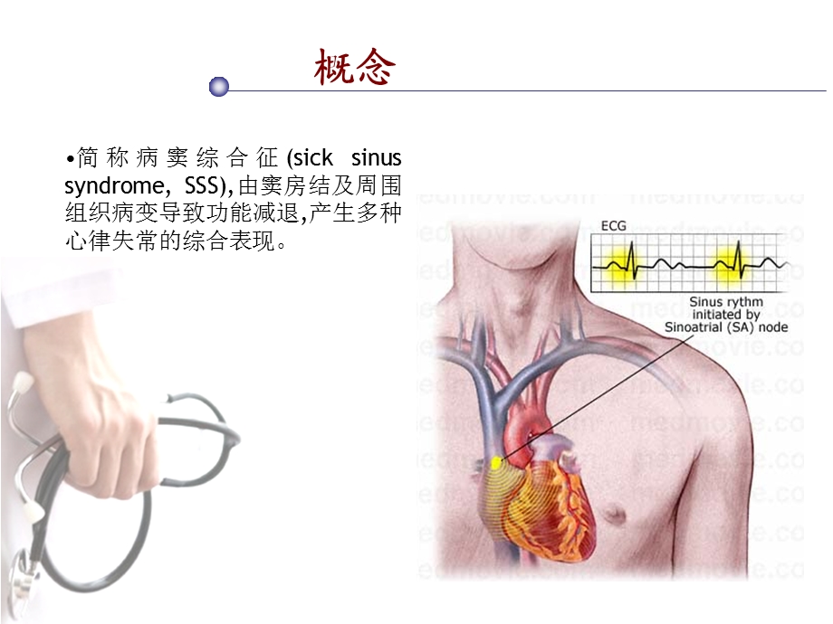 《病态窦房结综合征》PPT课件.ppt_第2页