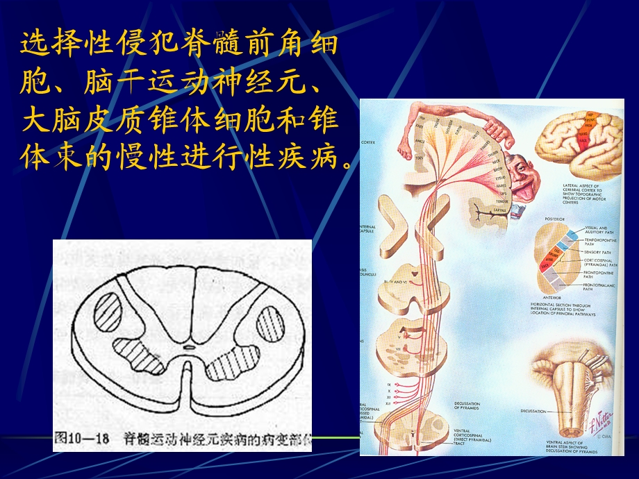 运动神经元病MotorneurondiseaseMND.ppt_第2页