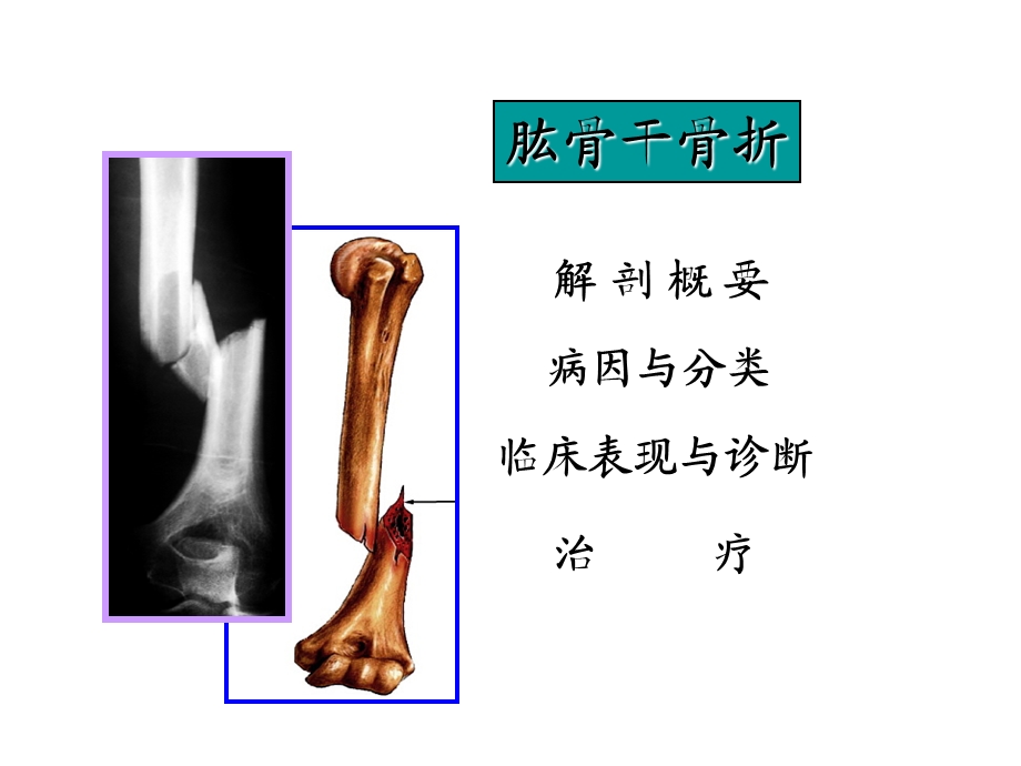 《肱骨干骨折》PPT课件.ppt_第1页