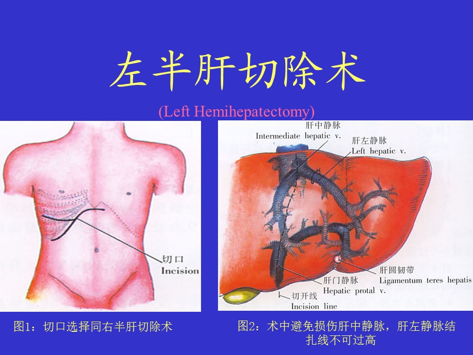 《左半肝切除术》PPT课件.ppt_第1页