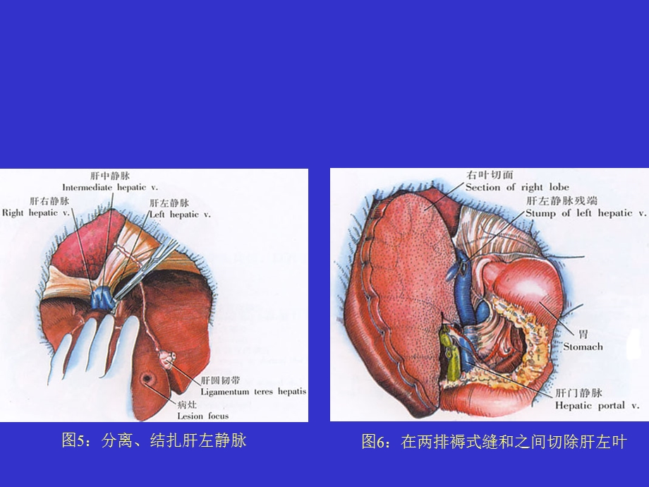 《左半肝切除术》PPT课件.ppt_第3页