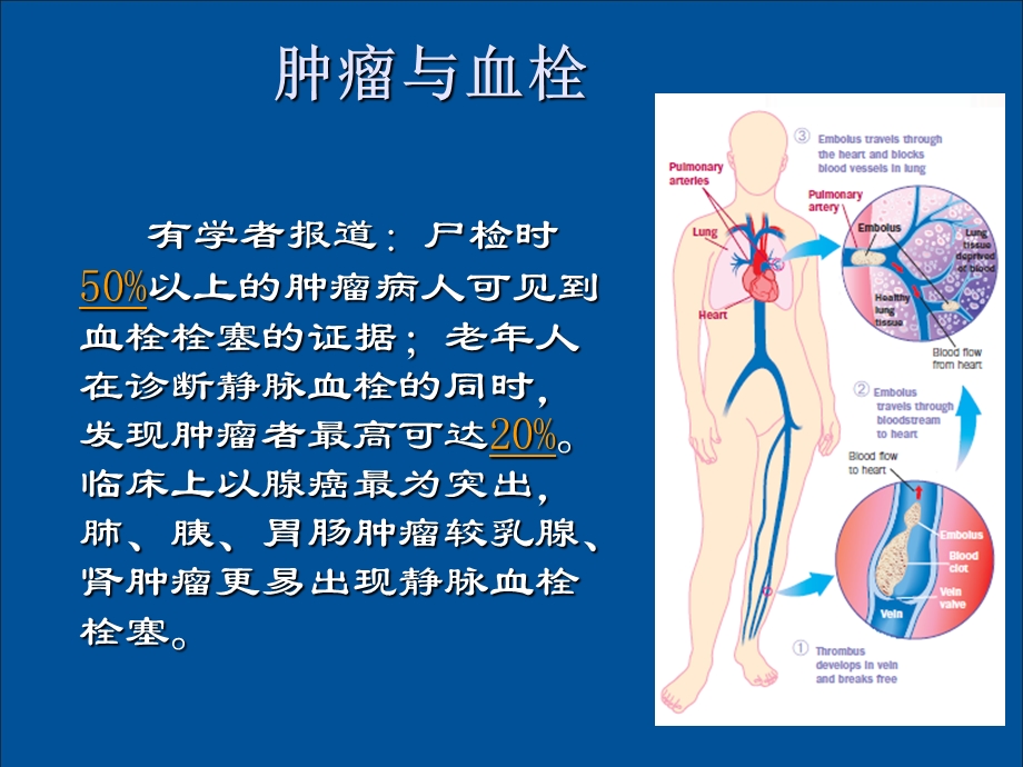 《肿瘤与血栓》PPT课件.ppt_第2页