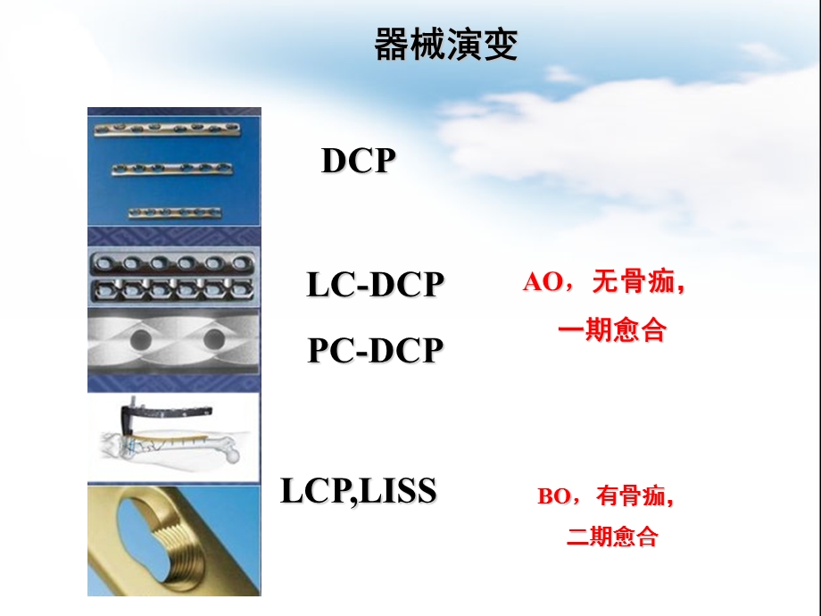 《锁定加压钢板》PPT课件.ppt_第2页