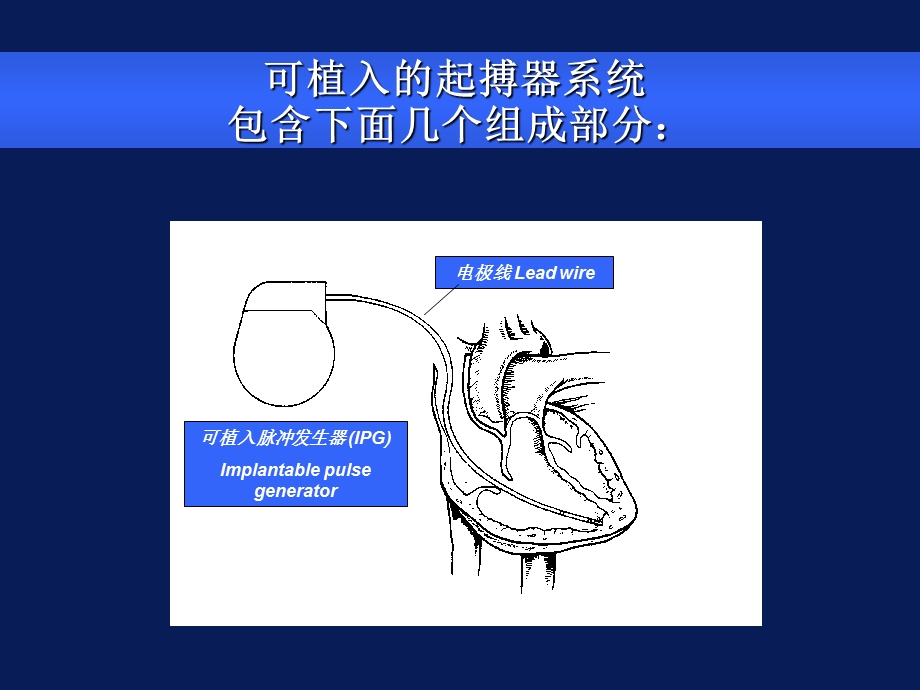 《起搏基本概念》PPT课件.ppt_第2页