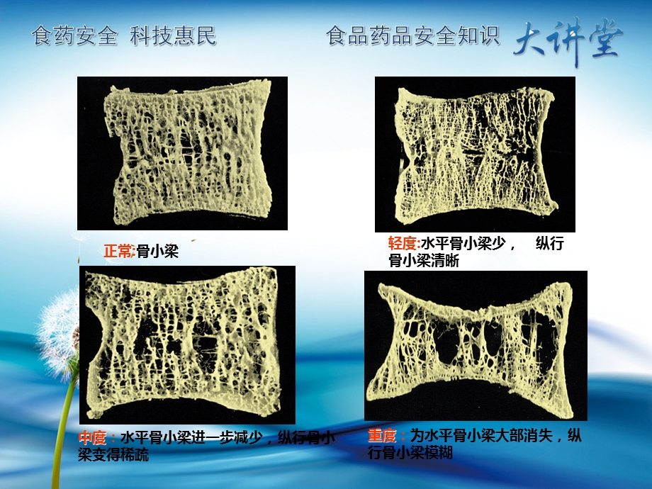 5预防骨质疏松症现在就行动专题讲座.ppt_第3页