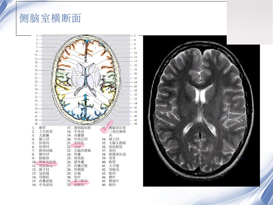 《室管膜瘤》PPT课件.ppt_第3页