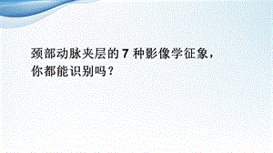 《颈部动脉夹层》PPT课件.ppt