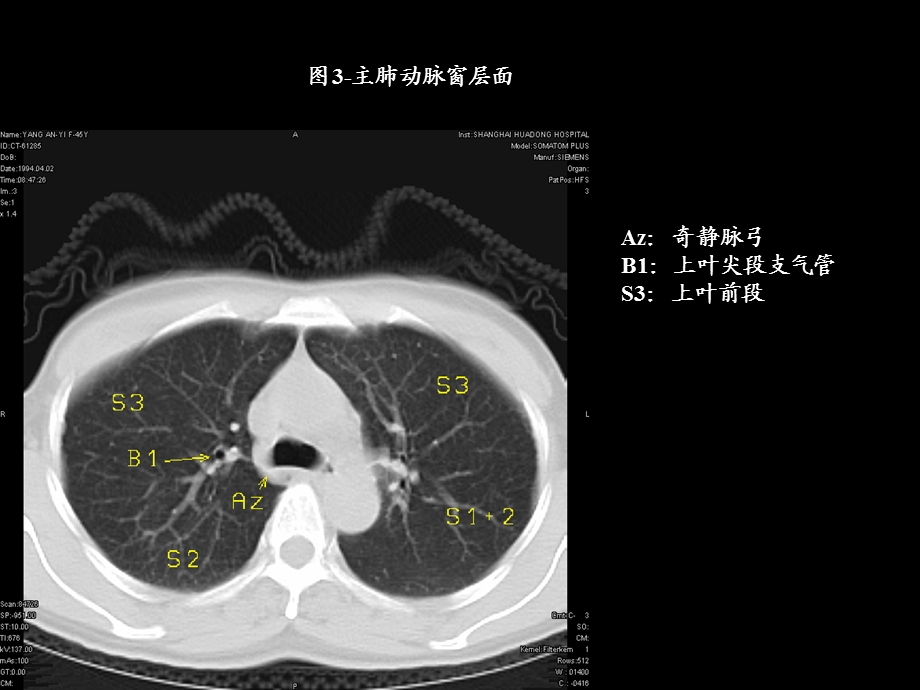 《胸部CT图片》PPT课件.ppt_第3页