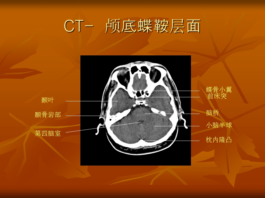 《颅脑断层解剖》PPT课件.ppt_第2页