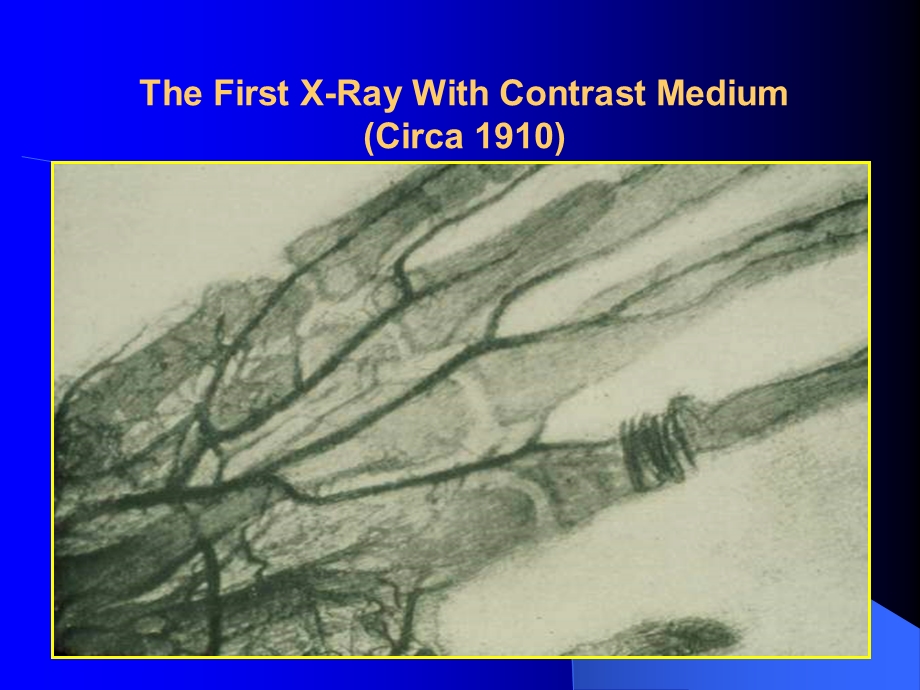 造影剂肾病CIN的防治contrastinducednephropathy.ppt_第2页