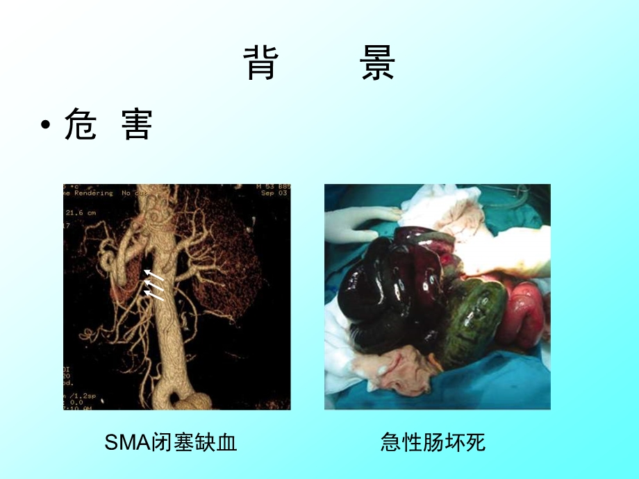 自发孤立型肠系膜上动脉夹层影像学特征在治疗策略中的价值课件.ppt_第3页