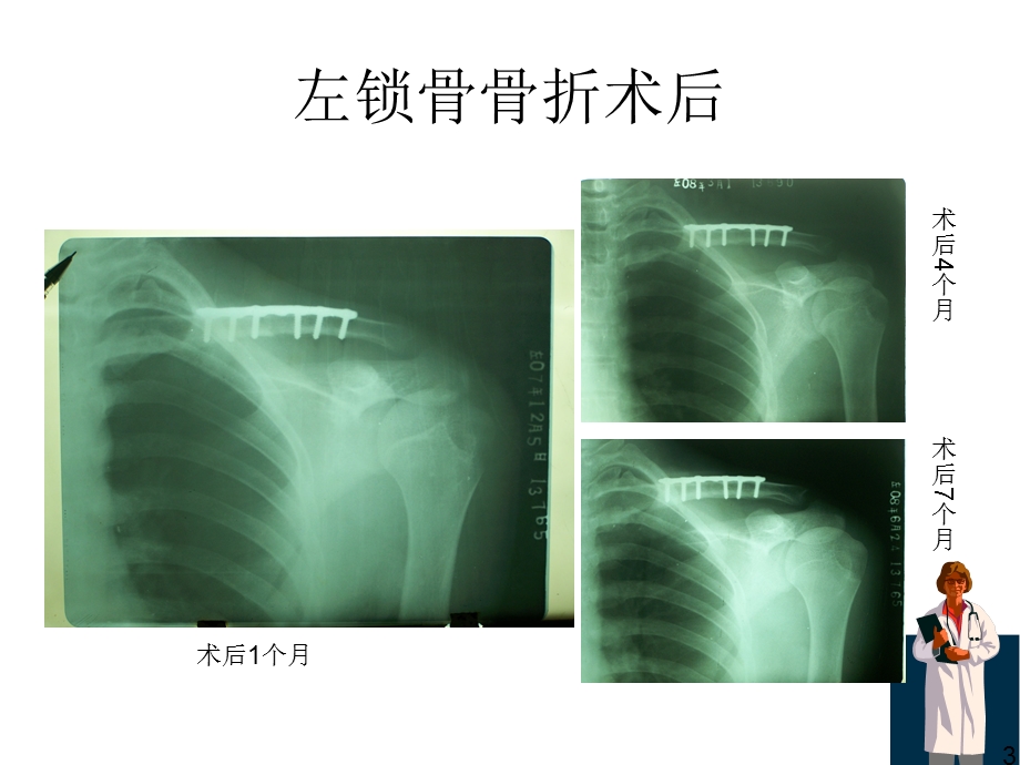 《骨折X线片汇总》PPT课件.ppt_第3页