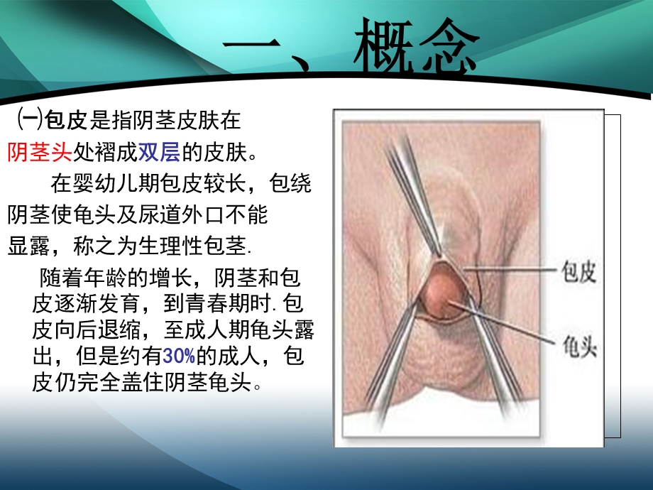 《包皮包茎》PPT课件.ppt_第3页