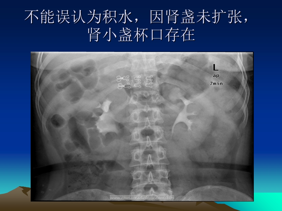 《壶腹型肾盂》PPT课件.ppt_第3页