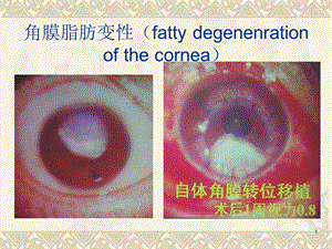 《角膜脂肪变性》PPT课件.ppt