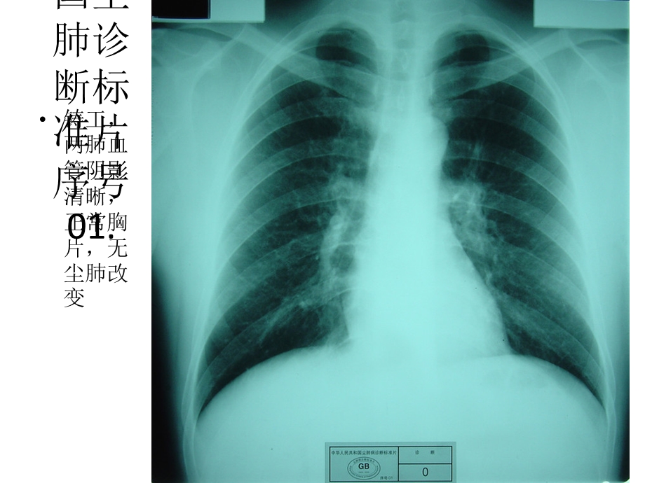 《尘肺标准片》PPT课件.ppt_第2页