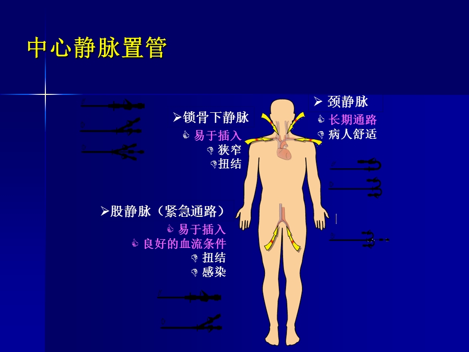 《深静脉置管术》PPT课件.ppt_第2页